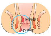 画像：内痔核