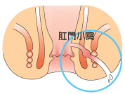 画像：痔瘻